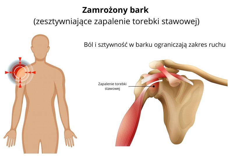 Bark zamrożony Rehabu